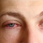 چشم صورتی یا ورم ملتحمه